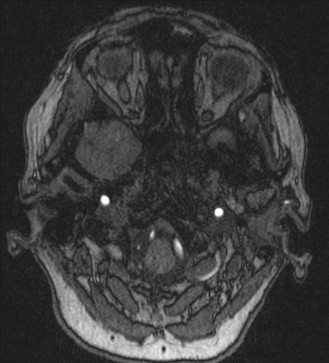 Basilar tip aneurysm (Radiopaedia 26504-26632 MRA 24).jpg