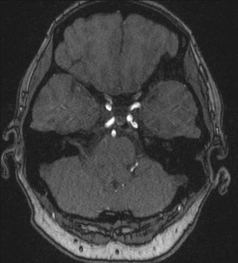 Basilar tip aneurysm (Radiopaedia 26504-26632 MRA 53).jpg
