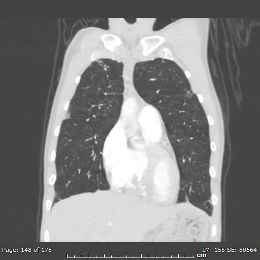Behçet disease (Radiopaedia 44247-47889 Coronal lung window 47).jpg