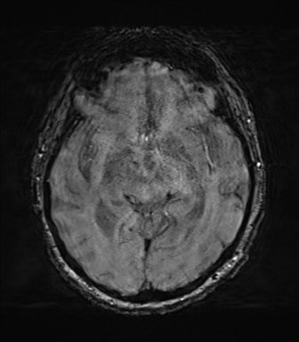 File:Behavioral variant frontotemporal dementia and late onset schizophrenia (Radiopaedia 52197-58083 Axial SWI 32).png
