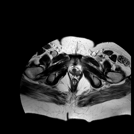 File:Benign seromucinous cystadenoma of the ovary (Radiopaedia 71065-81300 B 1).jpg
