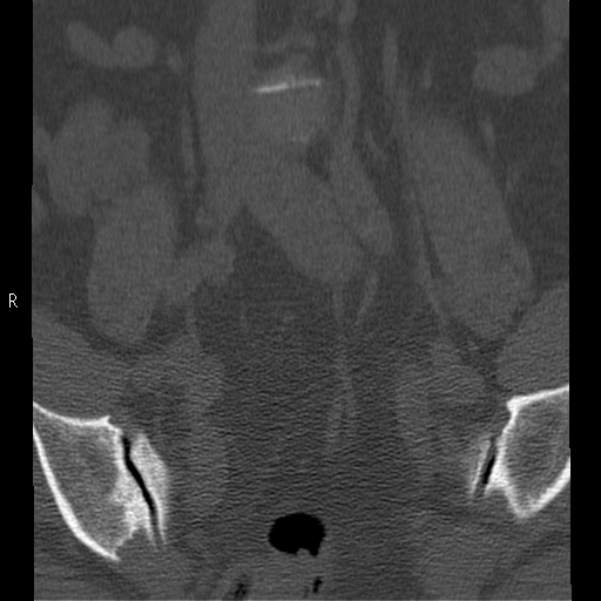 Bertolotti syndrome (Radiopaedia 24864-25128 Coronal bone window 6).jpg