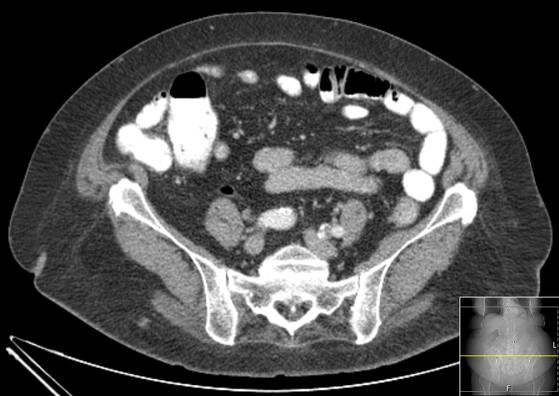 Bicameral celiacomesenteric aneurysm (Radiopaedia 55766-62327 A 47).jpg