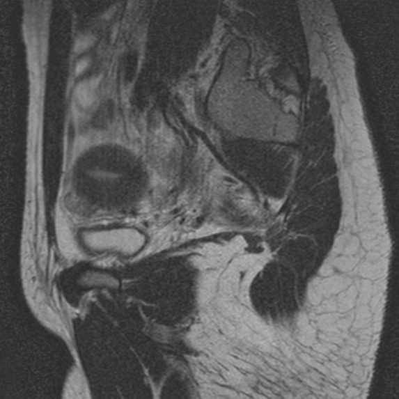 File:Bicornuate uterus (Radiopaedia 24677-24949 B 2).jpg