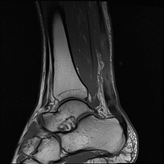 File:Bilateral Achilles tendon complete tear (Radiopaedia 81344-95051 Sagittal T1 23).jpg