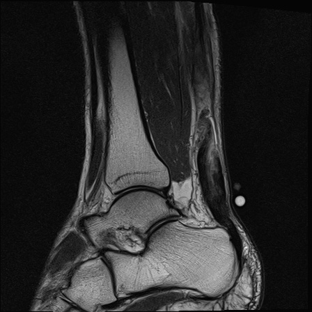 File:Bilateral Achilles tendon complete tear (Radiopaedia 81344-95051 Sagittal T2 8).jpg