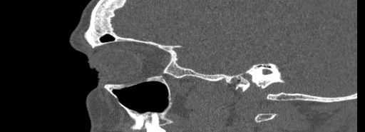 File:Bilateral Ectopic Infraorbital Nerves (Radiopaedia 49006-54084 Sagittal bone window 42).jpg