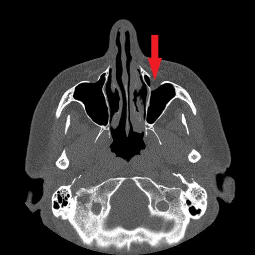 File:Bilateral Ectopic Infraorbital Nerves (Radiopaedia 49006-58325 Axial 2).jpg