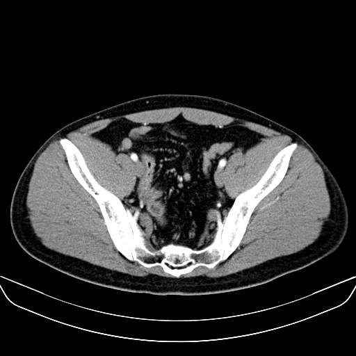 Bilateral accessory renal arteries with mild pelvi-ureteric junction (PUJ) obstruction (Radiopaedia 66357-75596 A 58).jpg