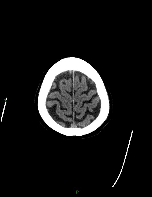 Bilateral acute middle cerebral artery territory infarcts (Radiopaedia 77319-89401 Axial non-contrast 81).jpg