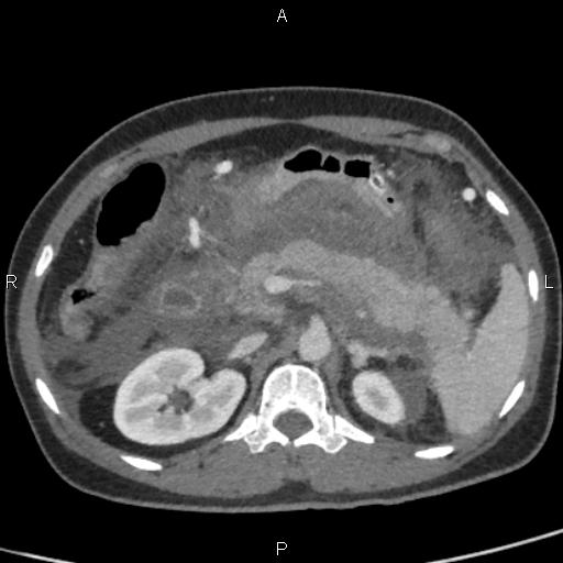 File:Bilateral adrenal gland hyperenhancement in pancreatitis (Radiopaedia 86642-102753 E 35).jpg