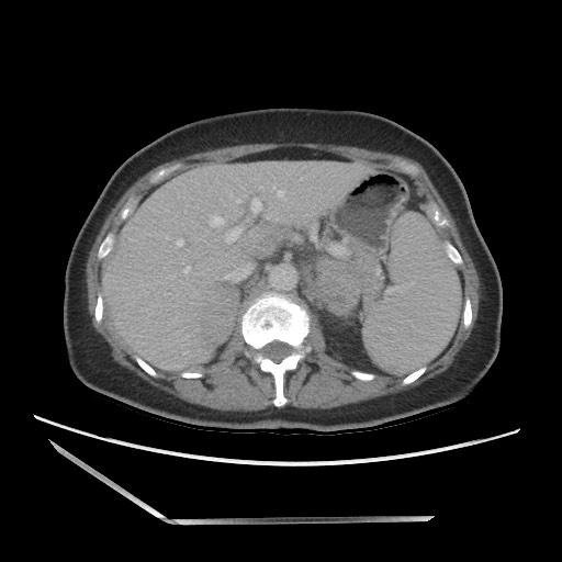 Bilateral adrenal granulocytic sarcomas (chloromas) (Radiopaedia 78375-91007 A 35).jpg