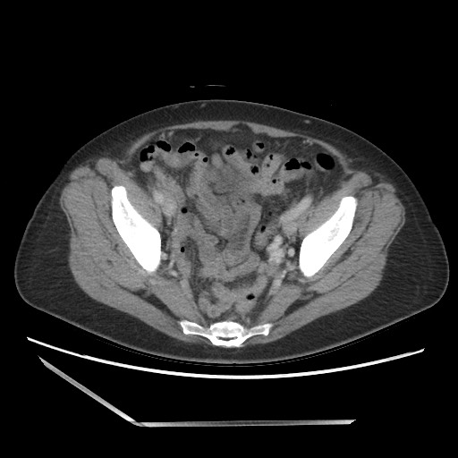 File:Bilateral adrenal granulocytic sarcomas (chloromas) (Radiopaedia 78375-91007 Axial 58).jpg