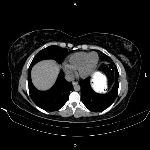 Bilateral adrenal myelolipoma (Radiopaedia 63058-71535 Axial non-contrast 7).jpg
