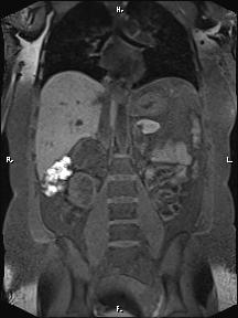 Bilateral adrenal myelolipoma (Radiopaedia 63058-71537 Coronal T1 fat sat 50).jpg
