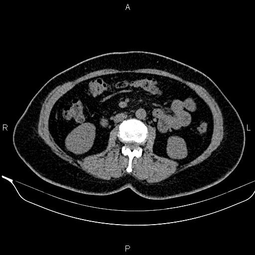 File:Bilateral benign adrenal adenomas (Radiopaedia 86912-103124 Axial non-contrast 56).jpg