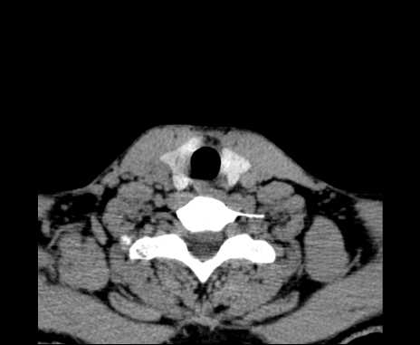 Bilateral carotid body tumors (Radiopaedia 61841-69870 Axial non-contrast 92).jpg