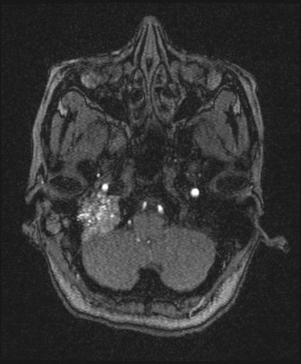 Bilateral carotid body tumors and right glomus jugulare tumor (Radiopaedia 20024-20060 Axial MRA 28).jpg