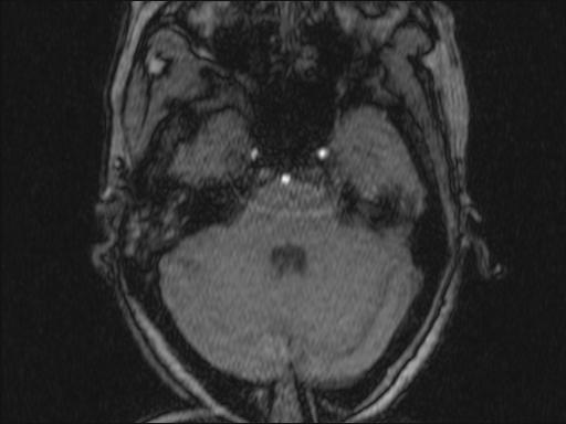 Bilateral carotid body tumors and right glomus jugulare tumor (Radiopaedia 20024-20060 Axial MRA 322).jpg