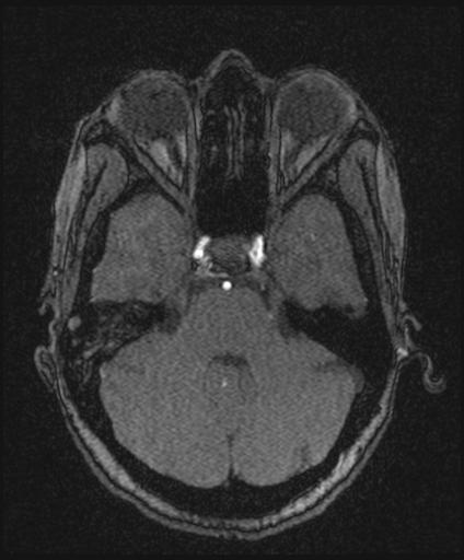 File:Bilateral carotid body tumors and right jugular paraganglioma (Radiopaedia 20024-20060 Axial 166).jpg