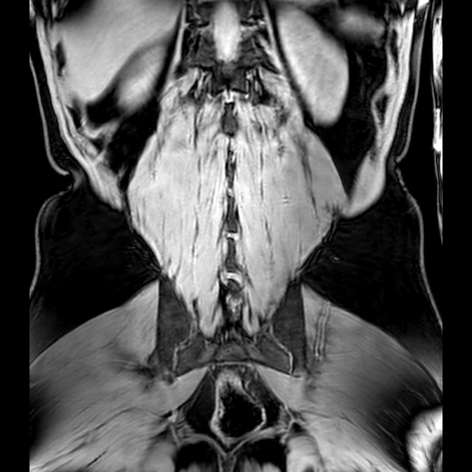 Bilateral conjoined nerve roots at different levels (Radiopaedia 73312-84063 Coronal WE 46).jpg