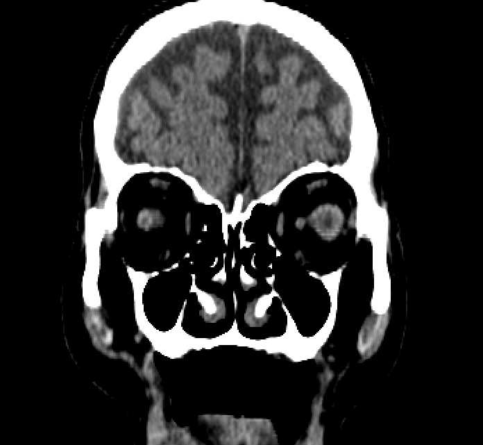 Bilateral ectopia lentis (Radiopaedia 89889-107013 Coronal non-contrast 54).jpg