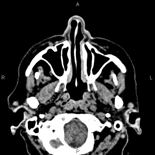 File:Bilateral enlargement of lacrimal glands - sarcoidosis (Radiopaedia 62627-70921 Axial non-contrast 6).jpg