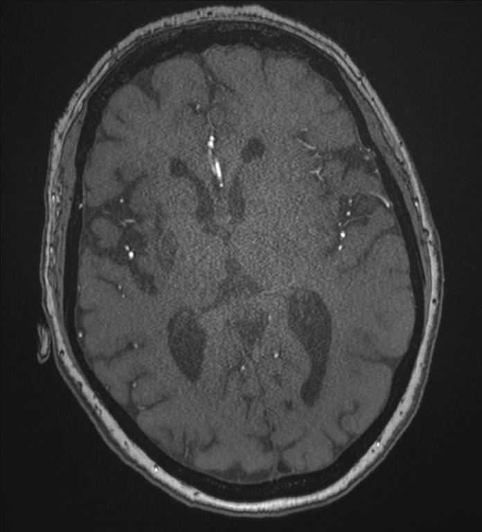 Bilateral fetal posterior communicating arteries (Radiopaedia 41286-44102 Axial MRA 116).png