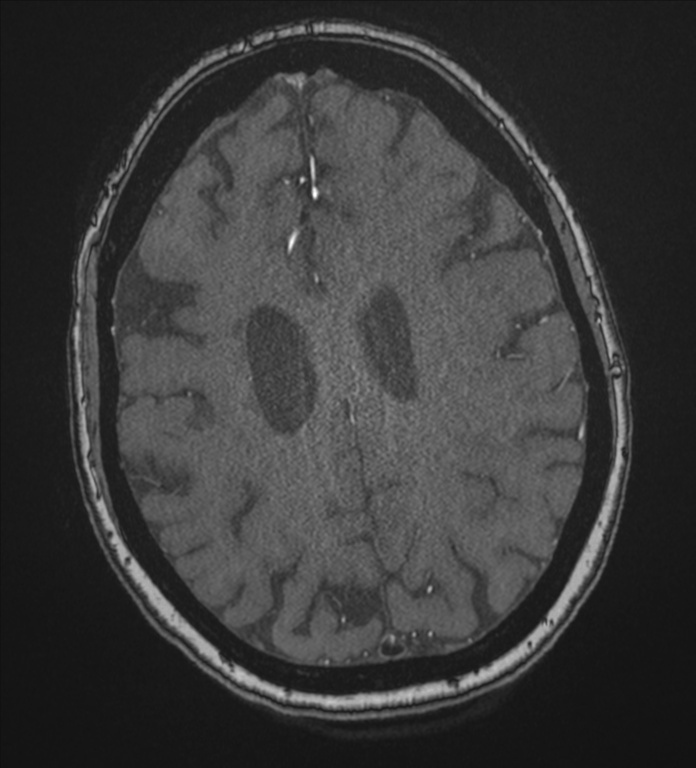 Bilateral fetal posterior communicating arteries (Radiopaedia 41286-44102 Axial MRA 162).png