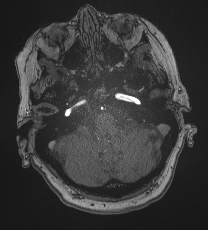 Bilateral fetal posterior communicating arteries (Radiopaedia 41286-44102 Axial MRA 30).png