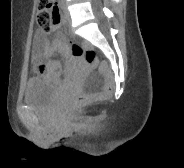 File:Bilateral mature cystic ovarian teratoma (Radiopaedia 88821-105592 D 31).jpg