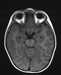 File:Bilateral mesial temporal polymicrogyria (Radiopaedia 76456-88181 Axial T1 9).jpg