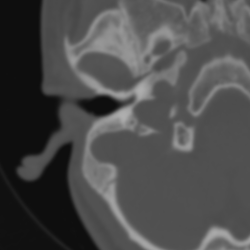 Bilateral otosclerosis (Radiopaedia 57237-64157 B 34).jpg