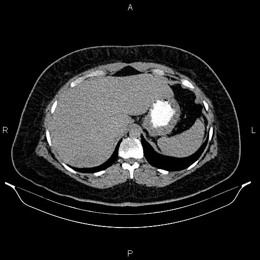 Bilateral ovarian dermoid cysts (Radiopaedia 85785-101603 Axial C+ delayed 7).jpg
