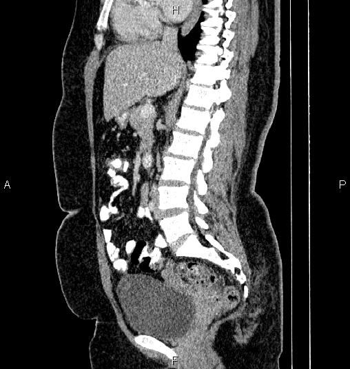 Bilateral ovarian dermoid cysts (Radiopaedia 85785-101603 D 43).jpg