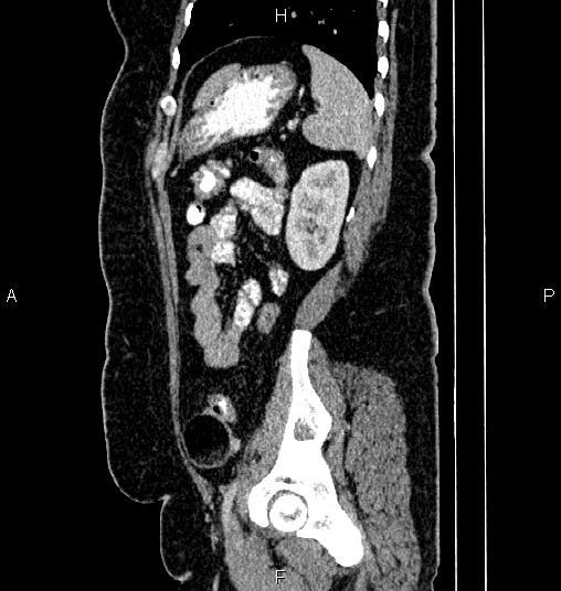 Bilateral ovarian dermoid cysts (Radiopaedia 85785-101603 D 73).jpg