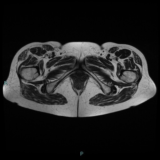 File:Bilateral ovarian fibroma (Radiopaedia 44568-48293 Axial T2 29).jpg