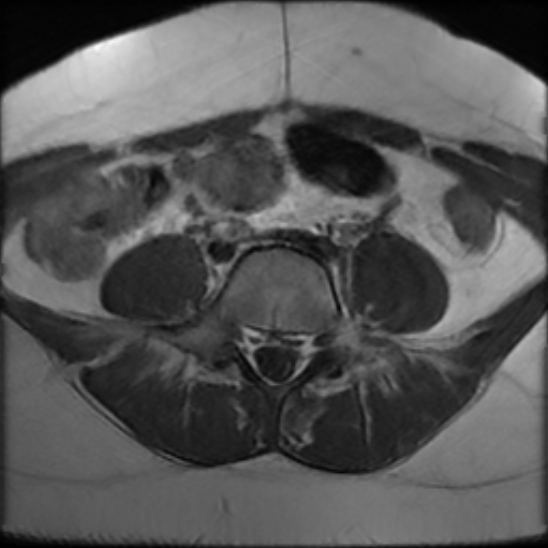 File:Bilateral ovarian fibrothecomas - adolescent (Radiopaedia 86604-102707 Axial T1 2).jpg