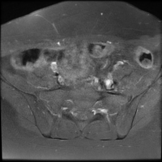 File:Bilateral ovarian fibrothecomas - adolescent (Radiopaedia 86604-102707 Axial T1 C+ fat sat 7).jpg