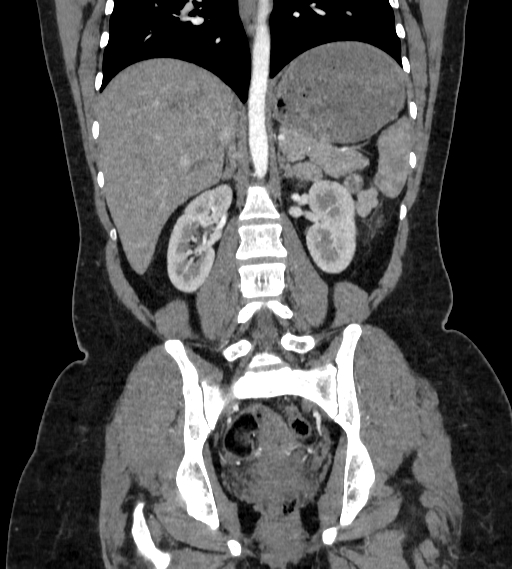 Bilateral ovarian mature cystic teratomas (Radiopaedia 79373-92457 B 53).jpg