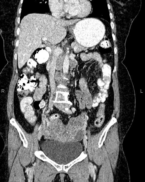 Bilateral ovarian serous cystadenocarcinoma (Radiopaedia 86062-101989 D 19).jpg