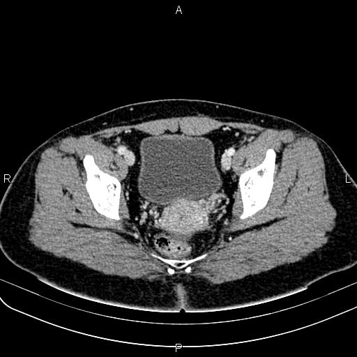 Bilateral ovarian teratoma (Radiopaedia 83131-97503 Axial With contrast 55).jpg