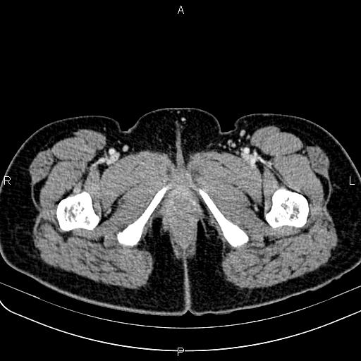File:Bilateral ovarian teratoma (Radiopaedia 83131-97503 Axial With contrast 90).jpg