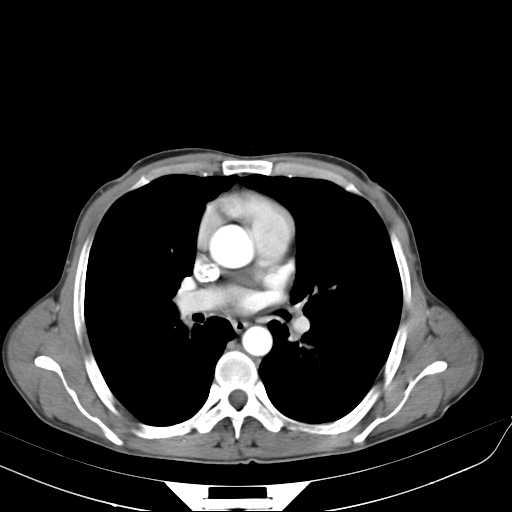 Bilateral parotid gland lymphoma (Radiopaedia 21038-20969 A 35).jpg