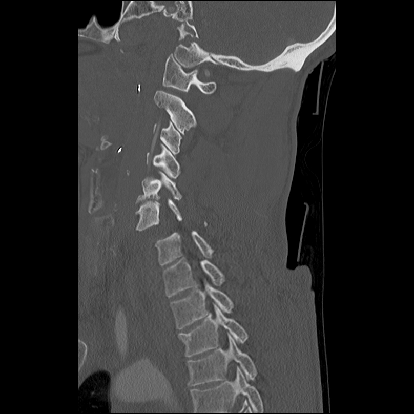 Bilateral perched facets with cord injury (Radiopaedia 45587-49713 Sagittal bone window 33).jpg