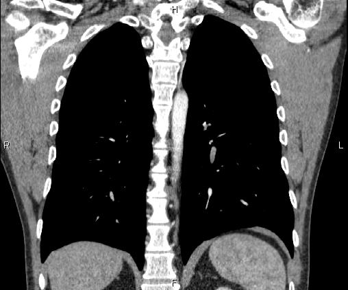 Bilateral pulmonary AVM (Radiopaedia 83134-97505 C 52).jpg