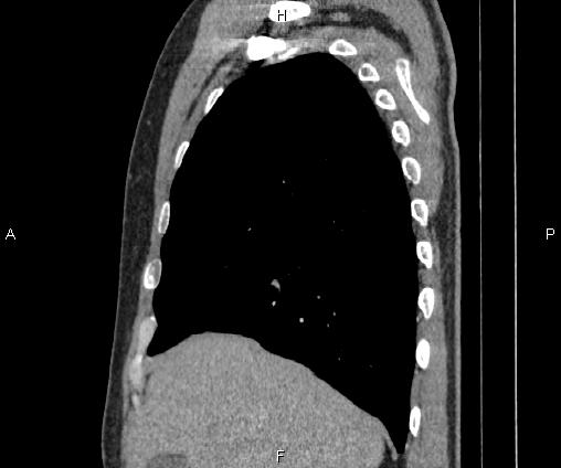 Bilateral pulmonary AVM (Radiopaedia 83134-97505 D 35).jpg
