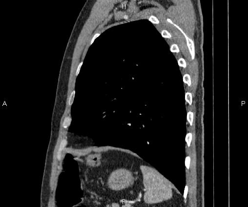 Bilateral pulmonary AVM (Radiopaedia 83134-97505 D 88).jpg
