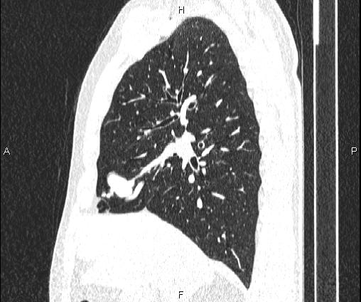 Bilateral pulmonary AVM (Radiopaedia 83134-97505 Sagittal lung window 46).jpg