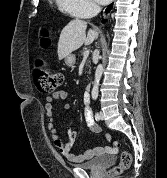 Bilateral rectus sheath hematomas (Radiopaedia 50778-56252 B 40).jpg